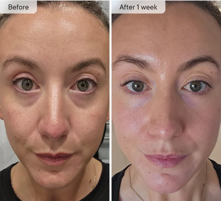 Microneedling Patches